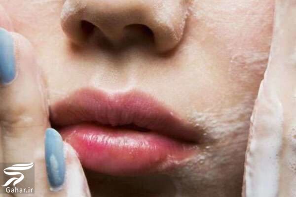هزینه فیشیال صورت, جدید 99 -گهر