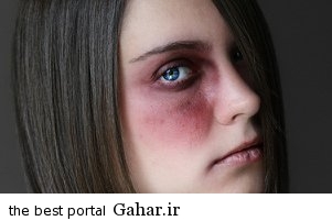 رفع سریع جای کبودی در بدن