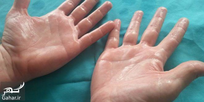 درمان عرق کف دست + علت عرق کردن دست چیست؟, جدید 1400 -❤️ گهر