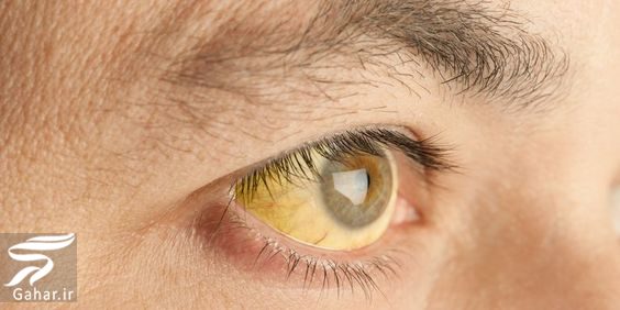 تشخیص 8 بیماری از روی چشم