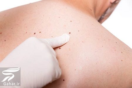 داشتن خال در نقاط مختلف بدن چه معنایی دارد؟