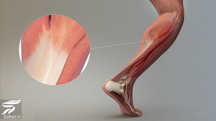 علل تاندونیت یا التهاب تاندون + نحوه تشخیص و درمان