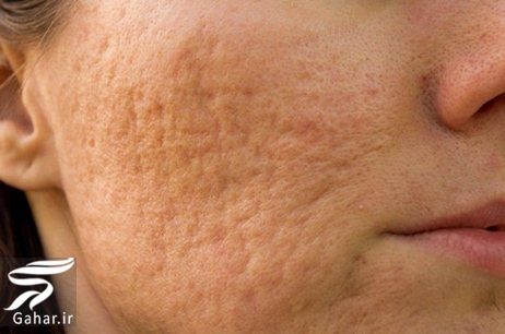 انواع زخم + روش های خانگی از بین بردن جای زخم