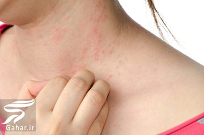علایم ضعف سیستم ایمنی بدن و راه های تقویت آن