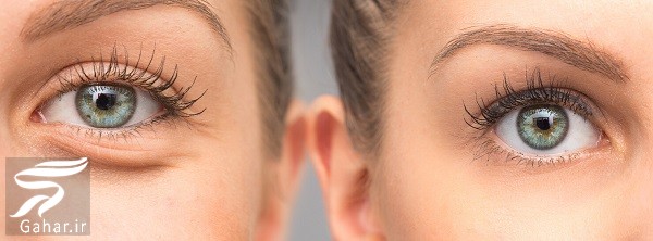 هزینه فیلر زیر چشم / هزینه تزریق ژل زیر چشم چقدر می شود؟