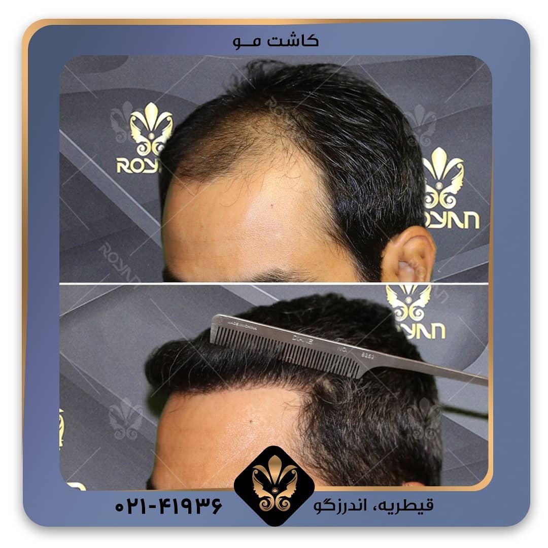 کاشت مو به روش FUE چگونه انجام می شود؟