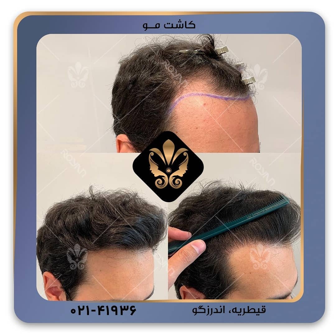 کاشت مو به روش FUE چگونه انجام می شود؟