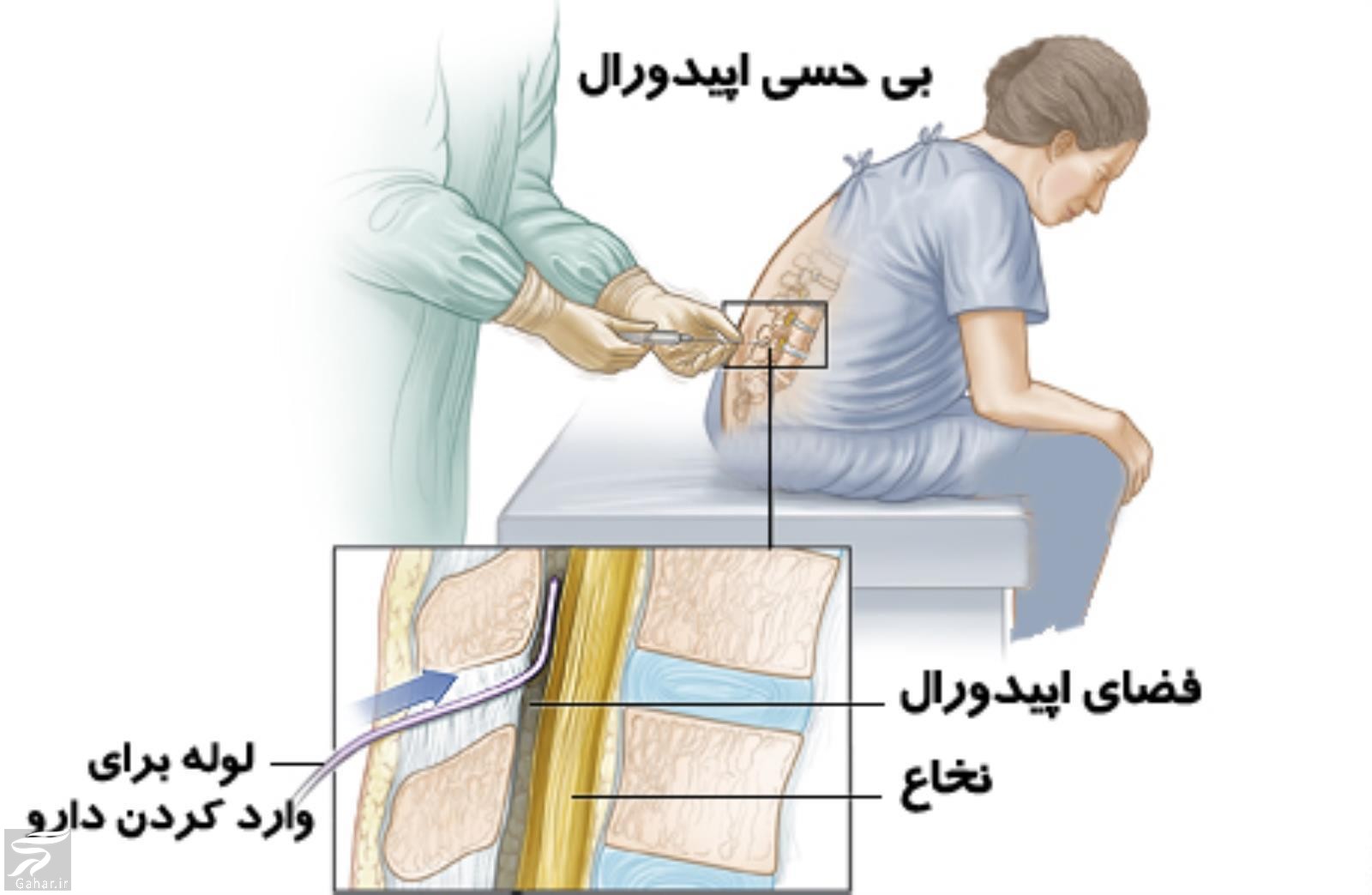 زایمان طبیعی به روش اپیدورال ; مزایا و معایب