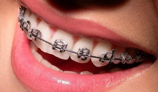 ایمپلنت دندان چیست و چه تاثیری دارد؟