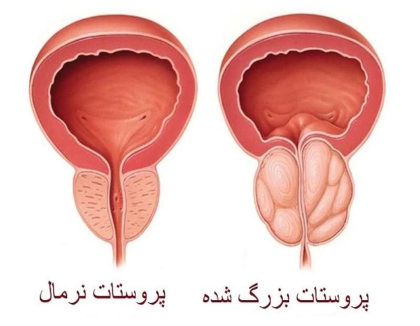 قرص پروترال 0/4 برای چیست + نحوه مصرف و عوارض