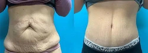 هزینه عمل ابدو + جزییات هزینه عمل ابدومینوپلاستی با بیمه