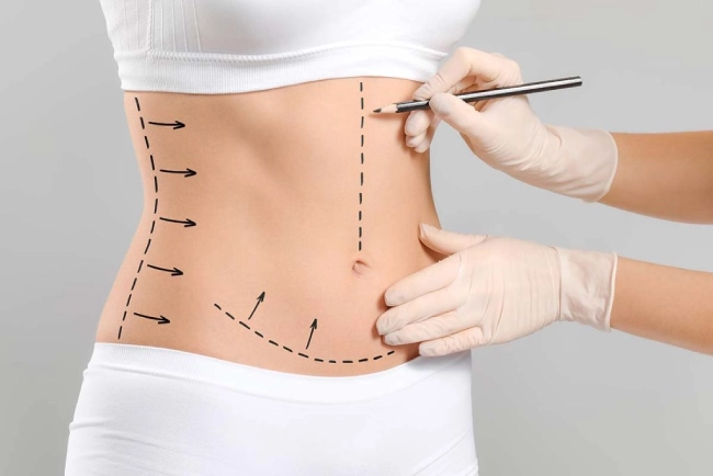 هزینه عمل ابدو + جزییات هزینه عمل ابدومینوپلاستی با بیمه