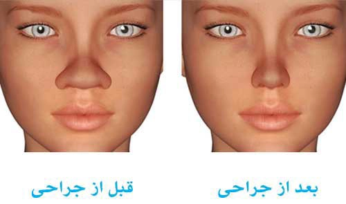 هزینه عمل بینی پهن و گوشتی + سن مناسب جراحی بینی گوشتی